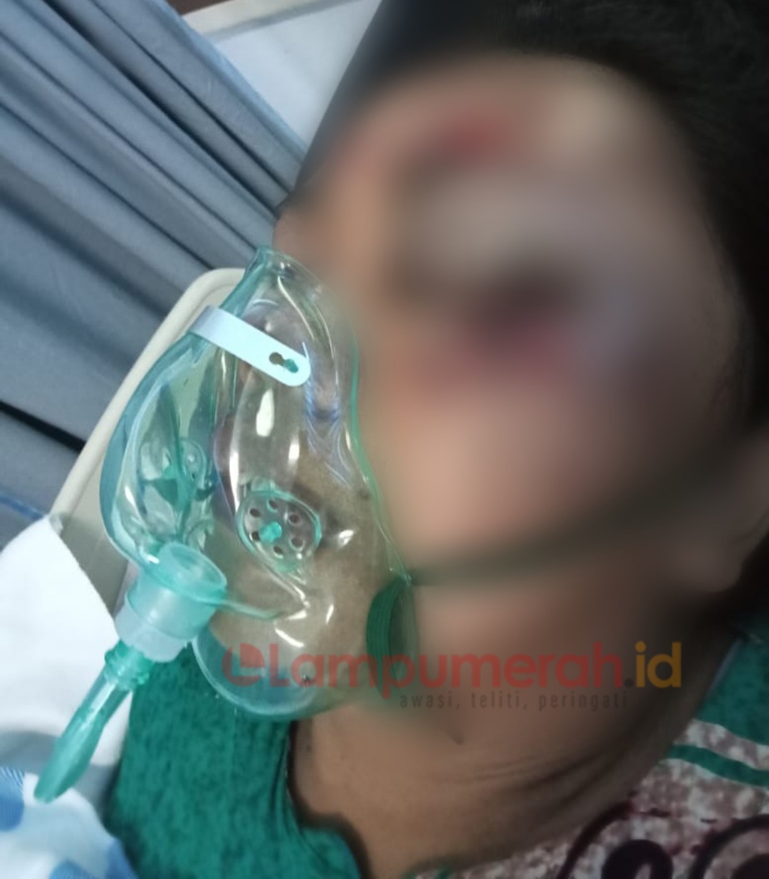 Teks foto : Korban KA alami luka lebam, saat dirawat di RSUD Sidoarjo.(ist)